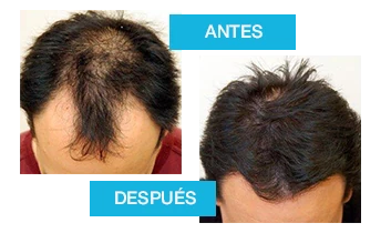 Cambio en el crecimiento del cabello tras usar Profolan